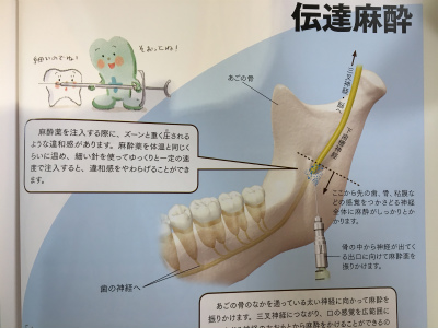麻酔を味方に | 名古屋市千種区 たなか歯科クリニック